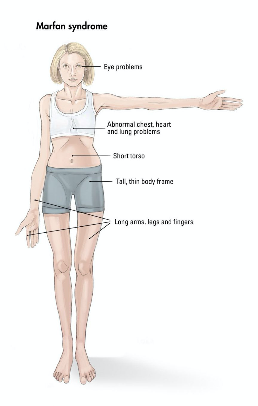 The Genetics Of Marfan Syndrome Biol2013h 2019