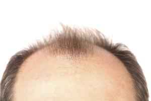Image result for male pattern baldness