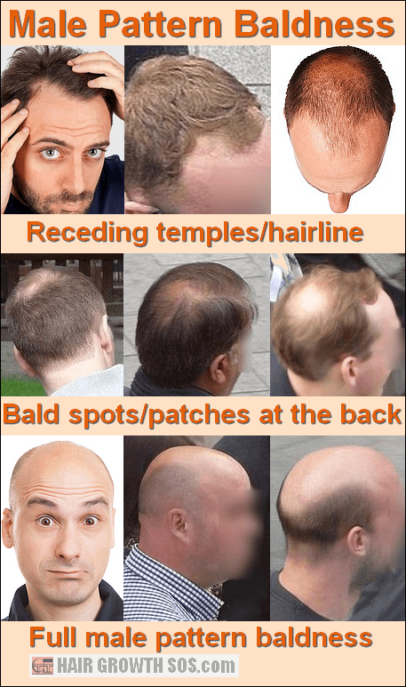 Image result for male pattern baldness